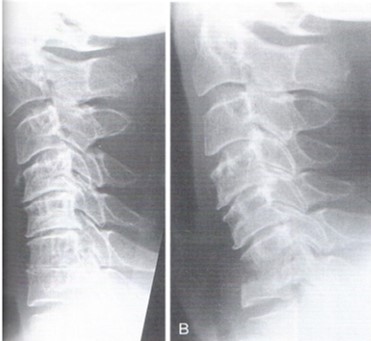 Spinal infection while not common [approx. 10% of all bone infection] may result in significant morbidity to a patient and in rare cases mortality. 