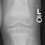 MRI of knee
