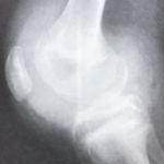 MRI of knee